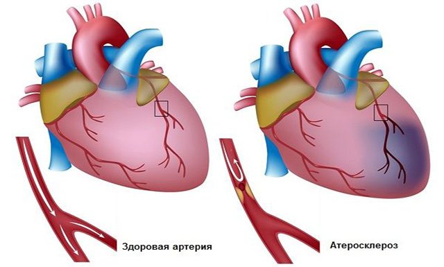 Що таке дифузний атеросклероз: особливості ураження судин головного мозку, серцевого мяза і нижніх кінцівок