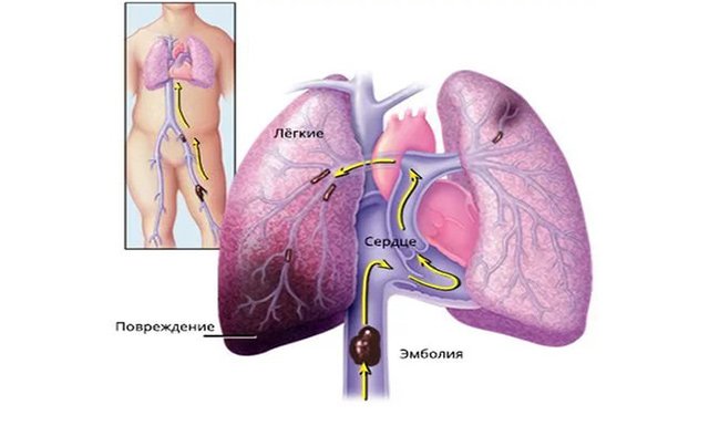 Атеросклероз легень – симптоми і лікування