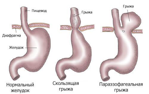 Грижа стравохідного отвору діафрагми