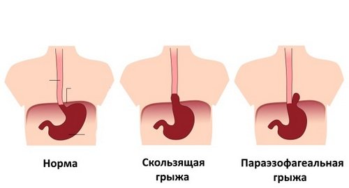 Грижа стравохідного отвору діафрагми