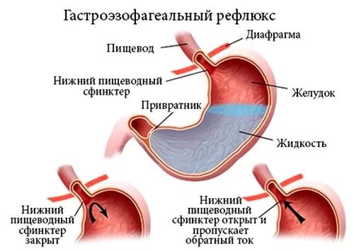 Лікування рефлюксу шлунка, його симптоми та причини