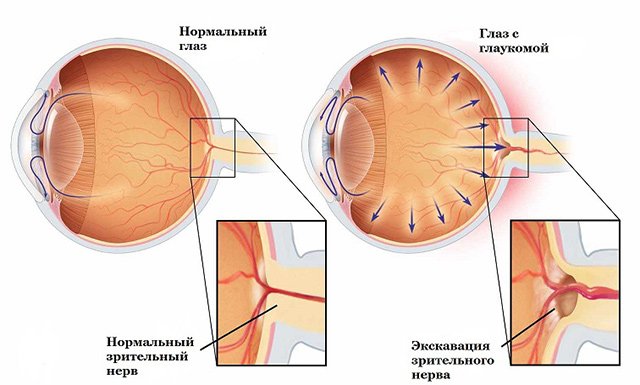 Очний тиск – симптоми і лікування