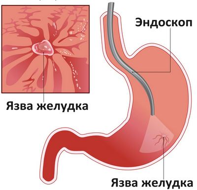Як лікувати виразку шлунка, її причини і симптоми