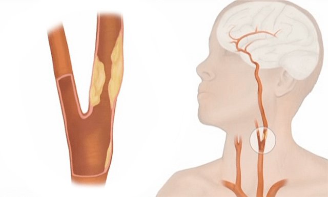 Атеросклероз судин шиї – симптоми і лікування