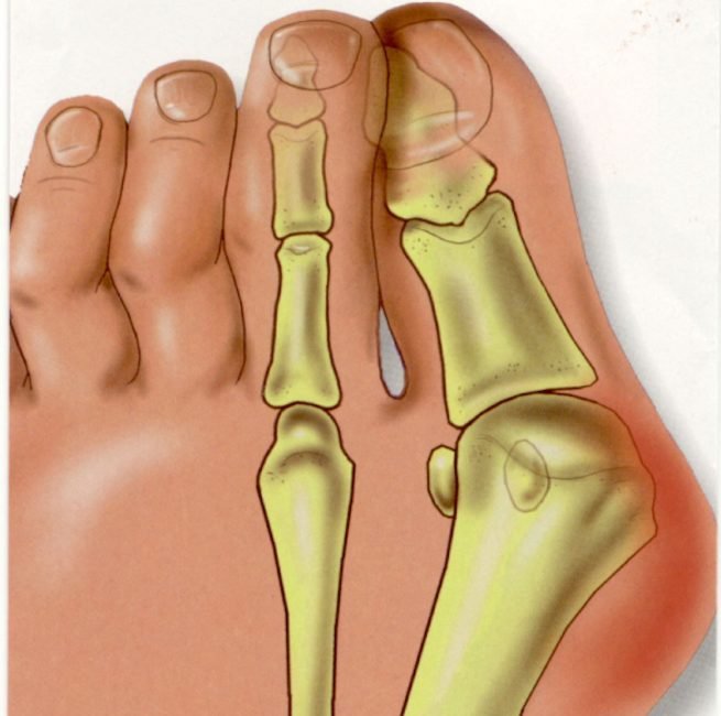 Велика кісточка на нозі: чи можна видаляти болящую кісточку і як її лікувати?