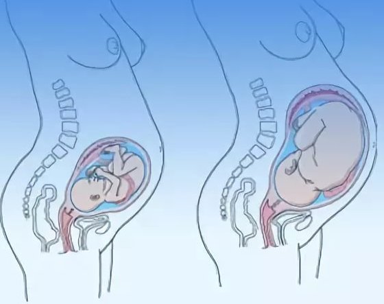 Нудота в третьому триместрі вагітності Часто в 3 триместрі: причини