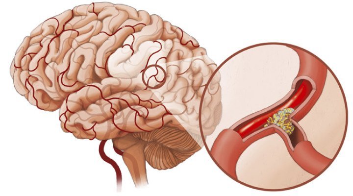Дистонія судин головного мозку: що це таке, симптоми і лікування