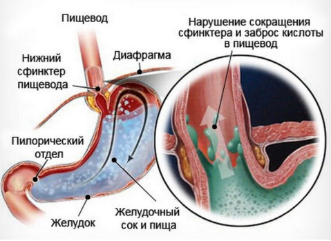 Печіння в шлунку: причини але не печія