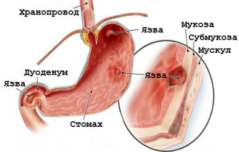Схема лікування виразки шлунка і дванадцятипалої кишки
