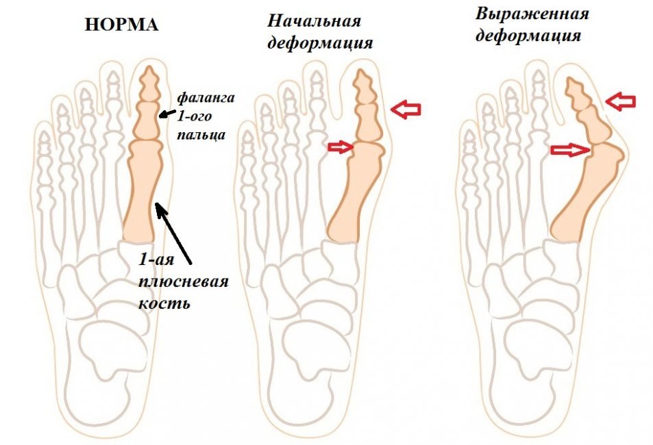Велика кісточка на нозі: чи можна видаляти болящую кісточку і як її лікувати?