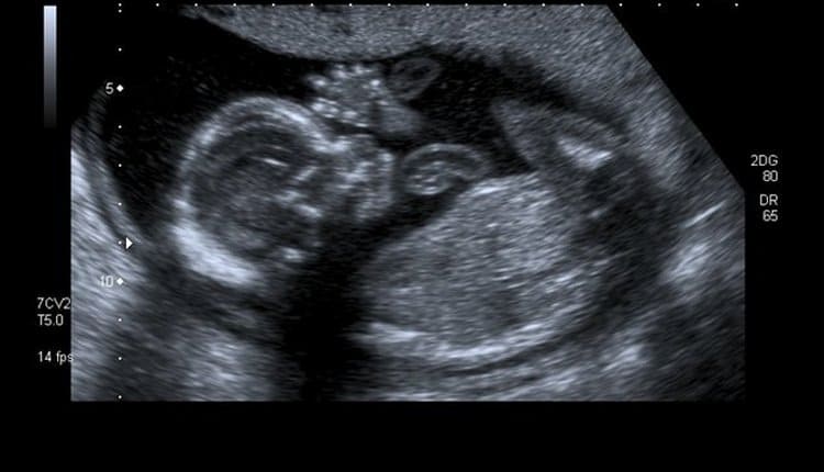 18 тиждень вагітності (2 й триместр) — мама і малюк