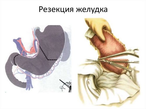Види та етапи резекції шлунка, реабілітаційний період