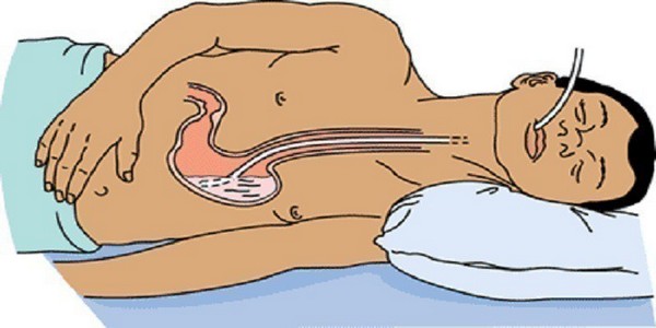Як виконується зондування шлунка, показання до процедури