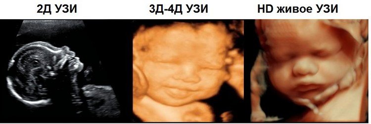 3Д та 4Д УЗД при вагітності: в чому відмінності