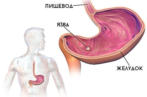 Ліки від гастриту і виразки шлунка, їх ознаки і симптоми