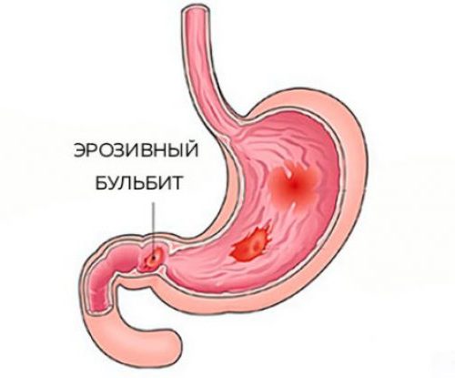 Як лікувати бульба шлунка, його причини і симптоми