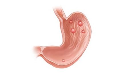 Що таке гіперплазія шлунка, її причини і лікування