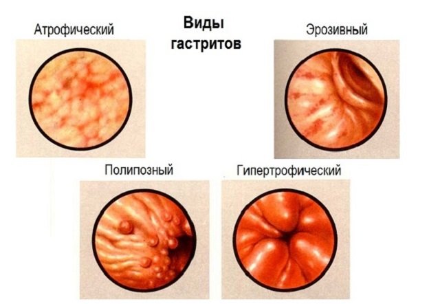 Види і симптоми гастриту шлунка, ознаки захворювання