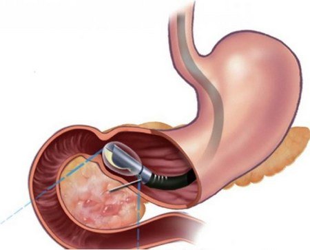 Ендоскопічне дослідження шлунка і підготовка до нього