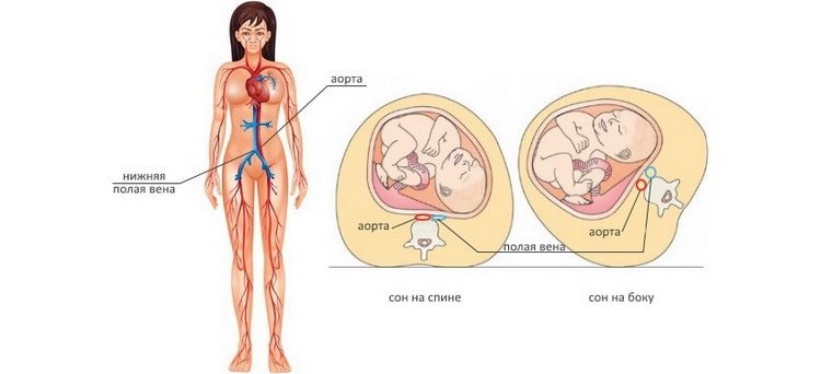 Дійсно вагітним не можна спати на спині: чому