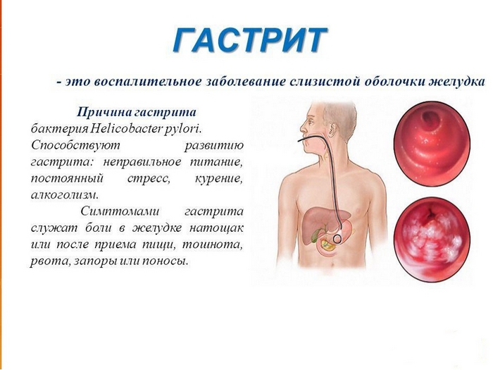 Види і симптоми гастриту шлунка, ознаки захворювання
