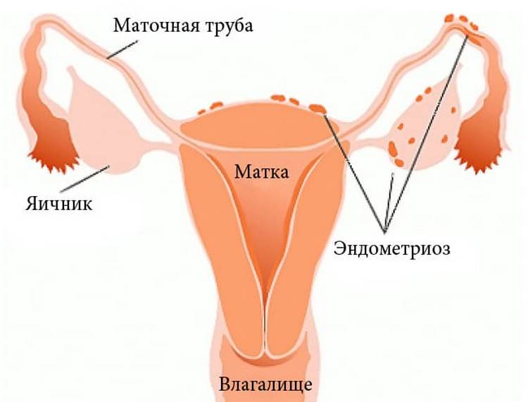 Ендометріоз при вагітності та плануванні