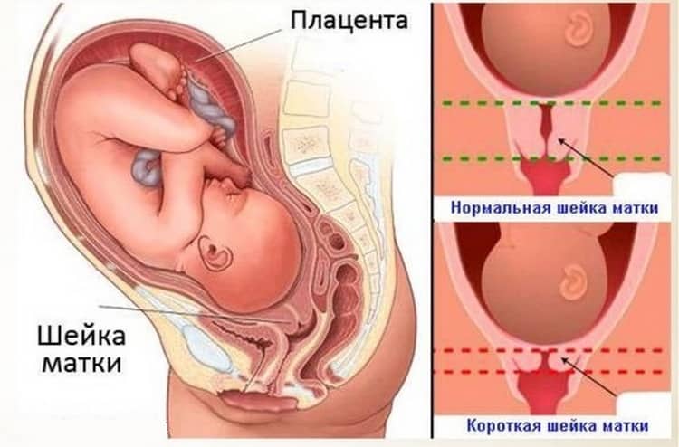 ИЦН при вагітності: симптоми, лікування, пологи