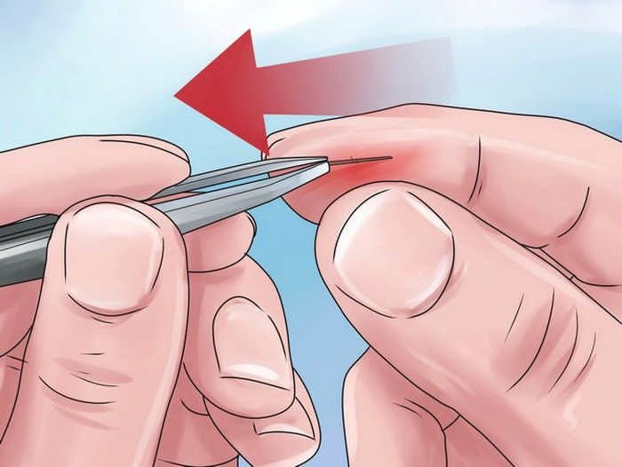 Як витягти скалку з пальця: найдієвіші способи