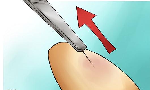 Як витягти скалку з пальця: найдієвіші способи