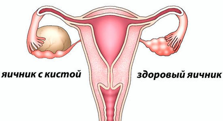 Кіста яєчника при вагітності: причини і лікування