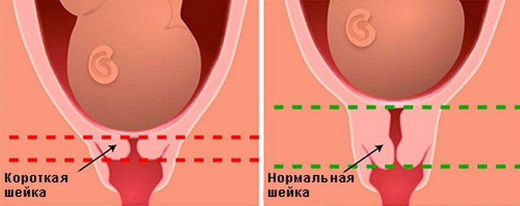 Коротка шийка матки при вагітності: симптоми