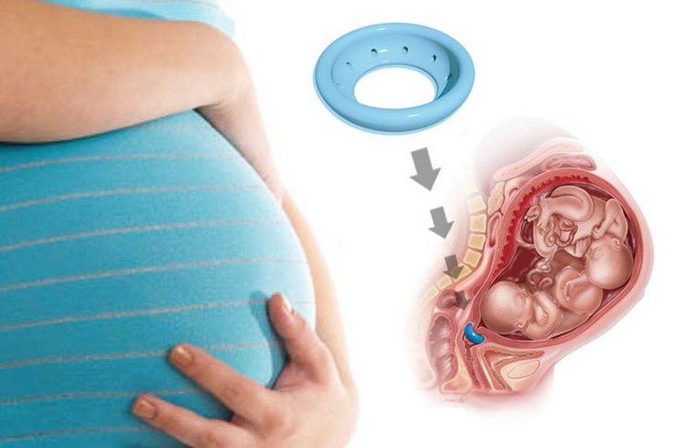 Коротка шийка матки при вагітності: симптоми
