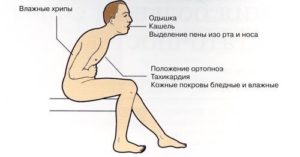 Невідкладна допомога при набряку легень Невідкладна допомога при набряку легень