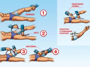 Невідкладна допомога при набряку легень Невідкладна допомога при набряку легень