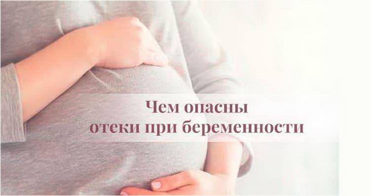 Набряки при вагітності: що робити