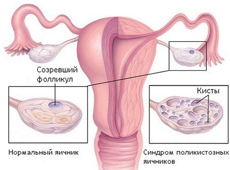 Полікістоз яєчників і вагітність: можлива