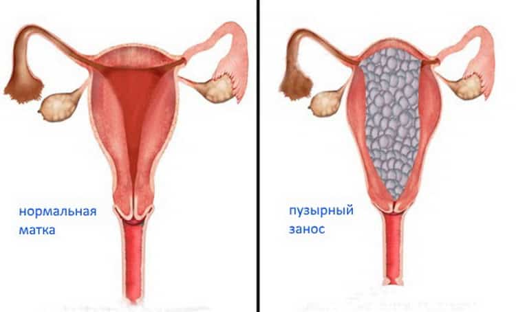 Пузирний замет при вагітності: симптоми, причини, лікування