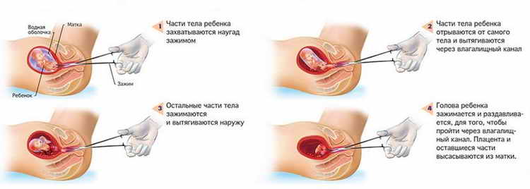 Завмерла вагітність: ознаки, причини, наслідки