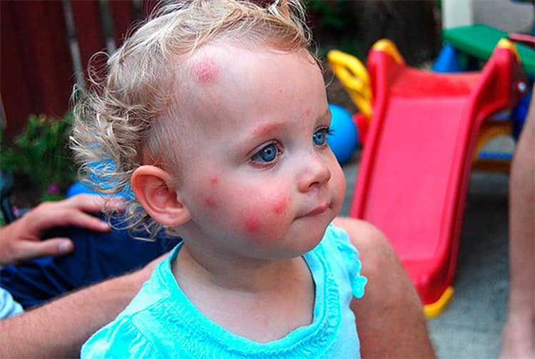Алергія на укуси комарів у дітей