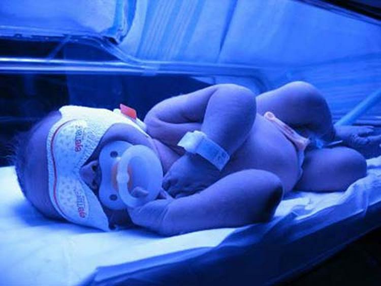 Білірубін у новонароджених: показники норми та відхилення