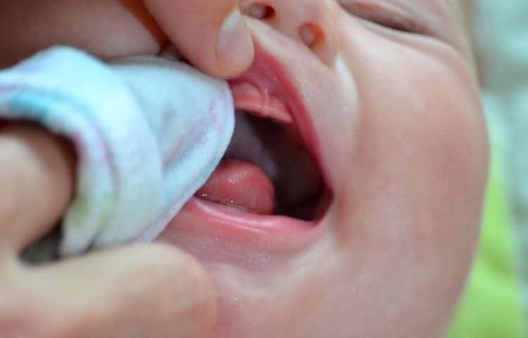 Ніж лікувати молочницю у роті в немовляти