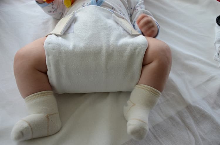 Дисплазія кульшових суглобів у новонародженого: ознаки, лікування