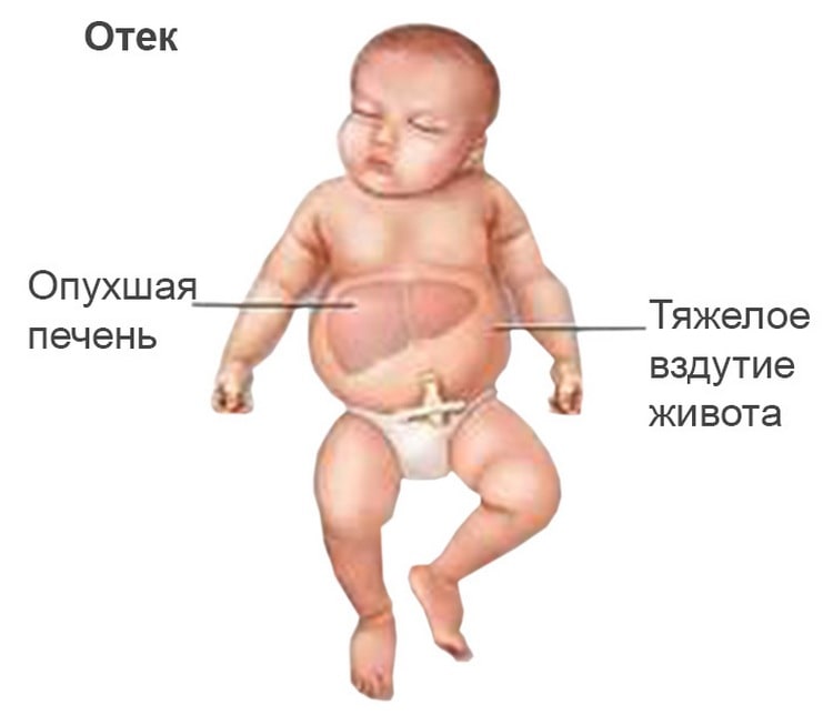 Гемолітична хвороба новонароджених: симптоми і лікування