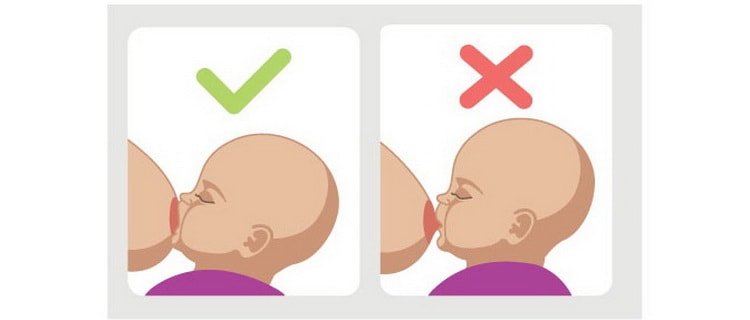 Як користуватися газовідвідної трубкою для новонароджених