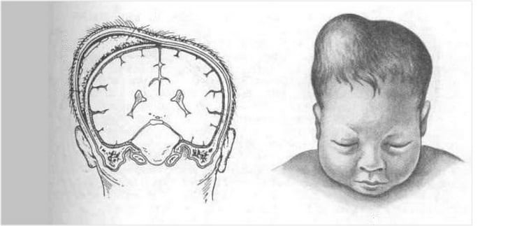 Кефалогематома у новонароджених на голові