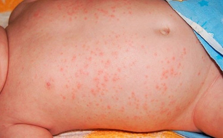 Ліки від алергії для дітей: які вибрати