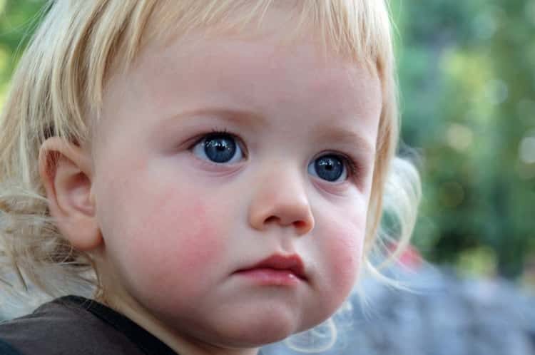 Основні симптоми алергії у дітей