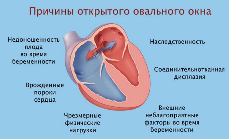 Овальне вікно в серці у новонародженого: причини і лікування