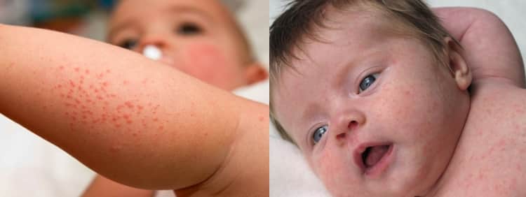 Пітниця у новонароджених: як виглядає і як лікувати