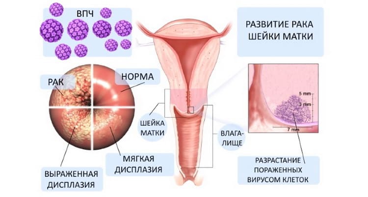 Щеплення від ВПЛ (раку шийки матки) дівчаткам: показання та відгуки